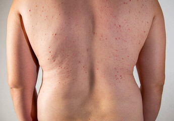 Red pimples on a man's back. Concept of inflammation of the sebaceous glands, dermatology, close-up