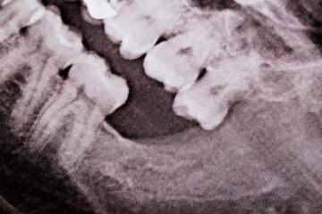 Empty space on an X-ray image in the gum after removal of an impacted wisdom tooth, close-up