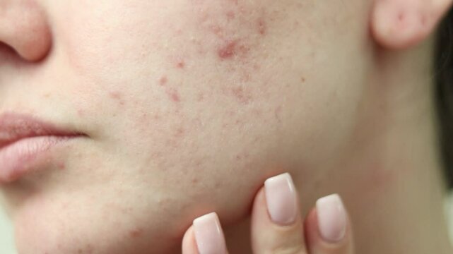  girl with acne problem on beige background, closeup.Girl shows acne on her face.redness treatment.post-acne. High quality 4k footage