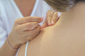 Acupuncture for a young woman. Traditional Chinese medicine