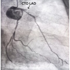 Coronary angiogram of left coronary artery during cardiac catheterization with contrast dye....