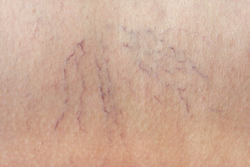 Close up of visible varicose veins on human skin showing vascular condition with prominent surface...
