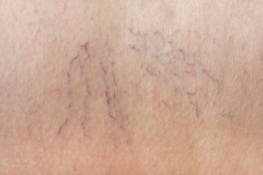 Close up of visible varicose veins on human skin showing vascular condition with prominent surface veins.