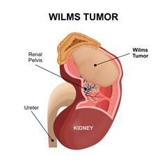 Wilms Tumor Kidney Tumor illustration