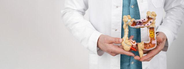 Anatomical intestines model with pathology in male hands, close-up. Treatment of colitis,...