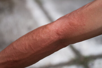 Photo of itchy bumps on the arm. This disease usually occurs due to several things, for example...