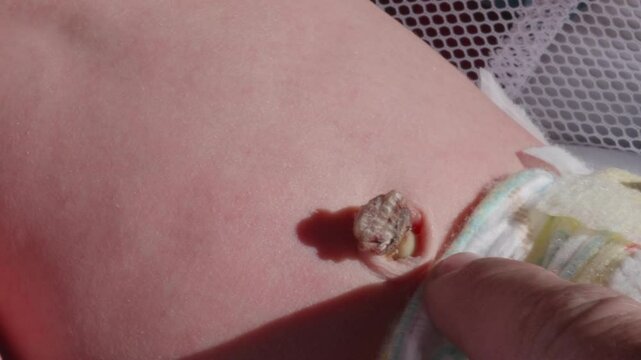 Newborn Belly Button Stump Closeup