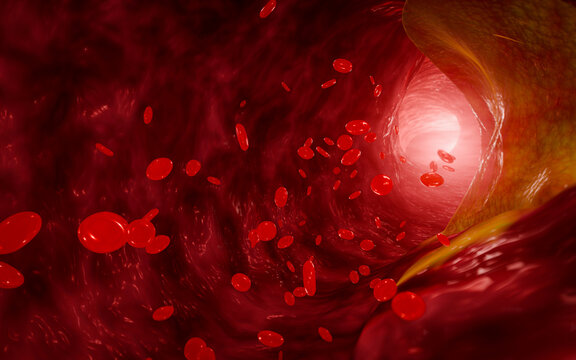 Hyperlipidemia or arteriosclerosis. Blocked artery concept and human blood vessel as a disease with cholesterol fat buildup clogging. Clogged arteries, Cholesterol plaque in the artery. 3D Rendering