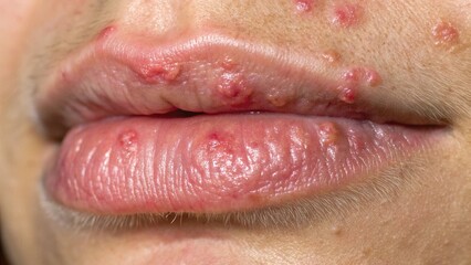Obraz premium Close-up of herpes simplex outbreak with painful blisters on lip. Visible redness, swelling, and fluid-filled vesicles. Detailed texture showing inflamed skin around affected area