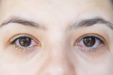 Fototapeta premium Red inflamed eyes with discharge caused by conjunctivitis, close-up of a human face, symptoms of eye infection, medical issue, ophthalmology, eye health, concept of healthcare