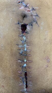 Post-Surgical Laparotomy Wound with Stitches and Infection, exploratory laparotomy operation