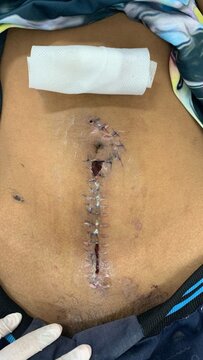 Post-Surgical Laparotomy Wound with Stitches and Infection, exploratory laparotomy operation