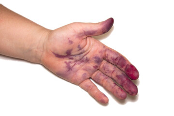 Fototapeta premium The photo shows a palm with stains of berry juice. The stains are dark purple and located on the palm and fingers. The palm is on a white background.