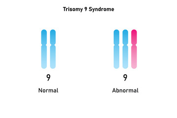 Trisomy 9 Syndrome Science Design. Vector Illustration.