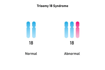 Trisomy 18 Syndrome Science Design. Vector Illustration.
