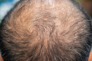 Cropped shot view of bald spot on Asian men's head with thin hair and white hair appear. Conceptual of hair problem on men's head.