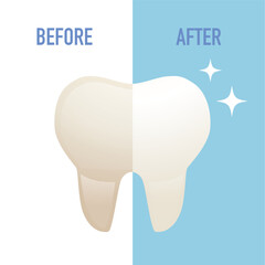 Tooth whitening modern illustration. Teeth Whitening. Before and after veneers installation isolated on white background