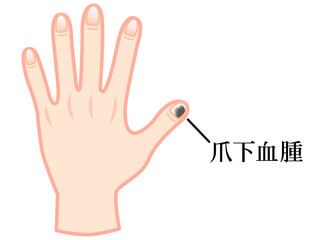 爪下血腫で内出血した手のイラスト素材3