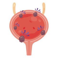 癌ができた膀胱のイラスト2