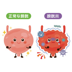 正常な膀胱と膀胱炎のキャラクターイラスト