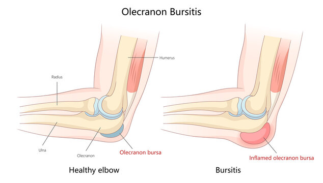 comparing healthy elbow to inflamed olecranon bursa, showing the effects of bursitis on the elbow joint diagram hand drawn schematic raster illustration. Medical science educational illustration