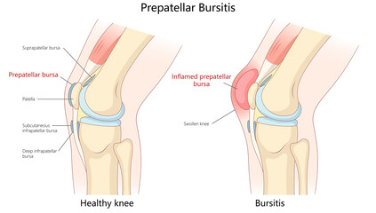 healthy knee with a knee affected by prepatellar bursitis, showing inflammation, swelling, and affected bursa anatomy diagram hand drawn raster illustration. Medical science educational illustration