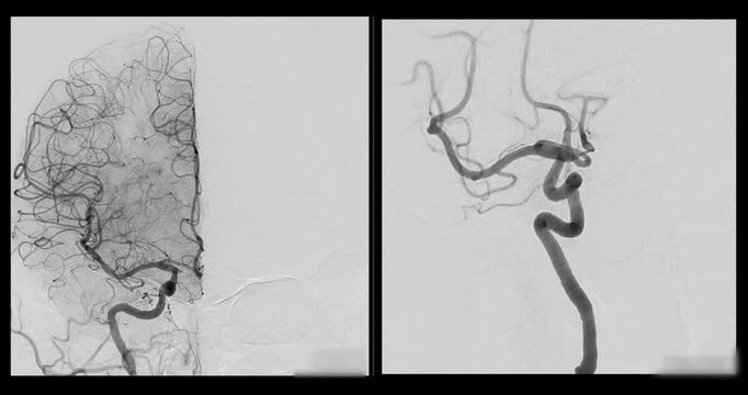 Cerebral angiography footage illustrating contrast dye movement through brain arteries, providing crucial insights into stroke, aneurysms, and vascular malformations.