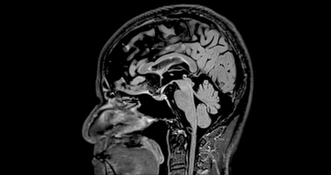 MRI Brain Sagittal T2W Flaire can help doctors look for conditions such as bleeding, swelling, tumors, infections, inflammation, damage from an injury or a stroke diseases.