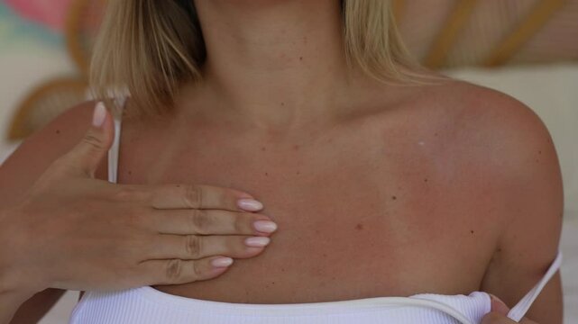 A young blonde woman applying soothing cream to sunburned skin on her chest with white swimsuit marks. Skincare routine for irritated, red skin after sun exposure. Sunburn relief and hydration