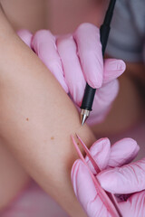A female specialist performs an electrolysis hair removal procedure, ensuring smooth and hair-free...