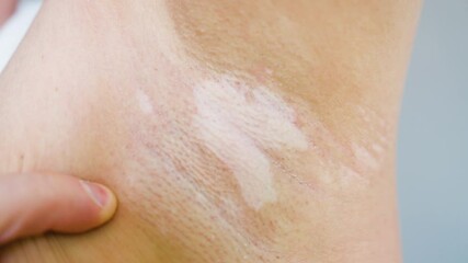 Person Examining Vitiligo Skin Condition in Armpit Area, Closeup of Depigmentation Patch. Dermatology Self-check