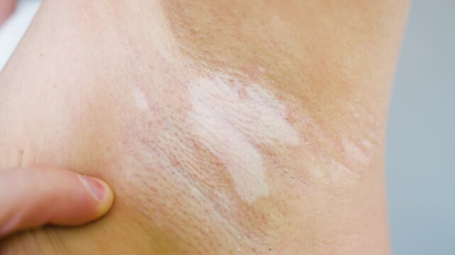 Person Examining Vitiligo Skin Condition in Armpit Area, Closeup of Depigmentation Patch. Dermatology Self-check
