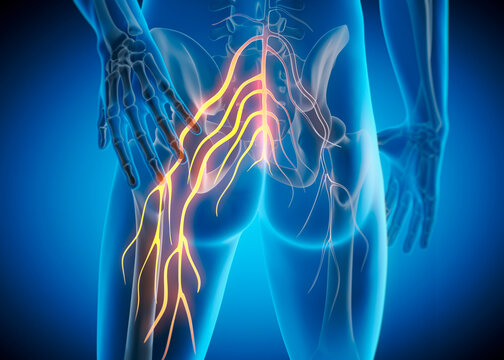 Medically accurate 3D illustration of a painful sciatic nerve cause by injury or irritation