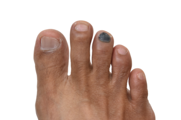 bruised toenail with subungual hematoma on human foot isolated on transparent