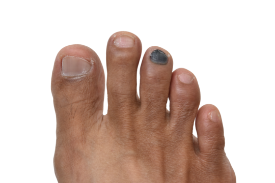 bruised toenail with subungual hematoma on human foot isolated on transparent