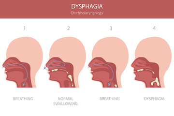 Oral dysphagia diseases. Otorhinolaryngology. Difficult swallowing. Medical infographic design. Vector illustration