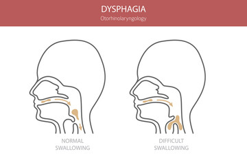 Oral dysphagia diseases. Otorhinolaryngology. Difficult swallowing. Medical infographic design. Vector illustration