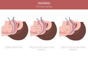 Sleep Apnea diseases. Otorhinolaryngology. Sleep related breathing disorder. Medical infographic design. Vector illustration