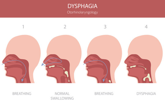 Oral dysphagia diseases. Otorhinolaryngology. Difficult swallowing. Medical infographic design. Vector illustration