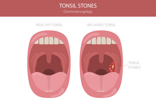 Tonsil stones diseases. Otorhinolaryngology. chronic caseous tonsillitis. Medical infographic design. Vector illustration