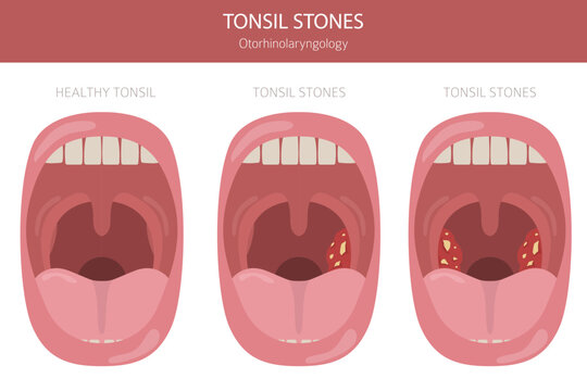 Tonsil stones diseases. Otorhinolaryngology. chronic caseous tonsillitis. Medical infographic design. Vector illustration