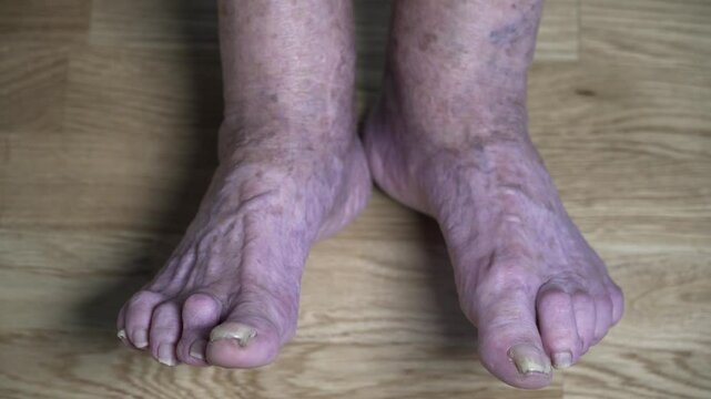 Patients legs of an old woman. Varicose veins on a female legs. Phlebology. Feet of an old woman with mutilated sick nails. Close up varicose veins on the leg. The old woman unkempt toenails.