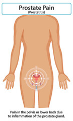 Understanding Prostate Pain and Inflammation