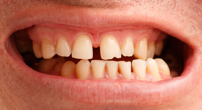 A man's mouth is open with a gap between his teeth