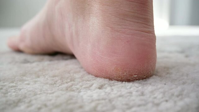 The woman has cracked heels and dry skin. Plantar hyperkeratosis