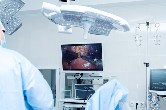 Laparoscopic cholecystectomy in the operating room, abdominal surgery, gallbladder removal. Surgeons in an operating room engage in a procedure, dressed in blue surgical gowns and caps.