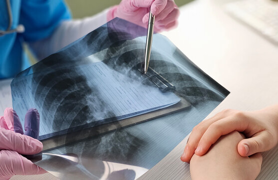 Lung radiography concept. radiology doctor examining at chest x ray film of patient at hospital concept - Powered by Adobe