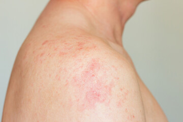 Adult man suffering from allergic redness of skin on the shoulder and back. Red rash on the...