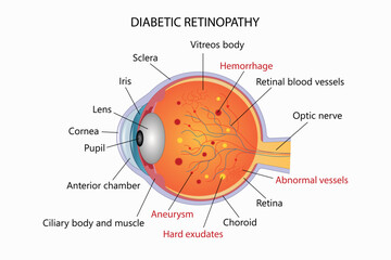 Diabetic retinopathy image, medical infographic.