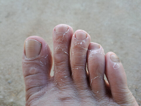 Foot Eczema epidermis The palms and fingers are peeling from the air that is too dry and cold. or the body lacks certain vitamins and minerals Including chemical allergies.